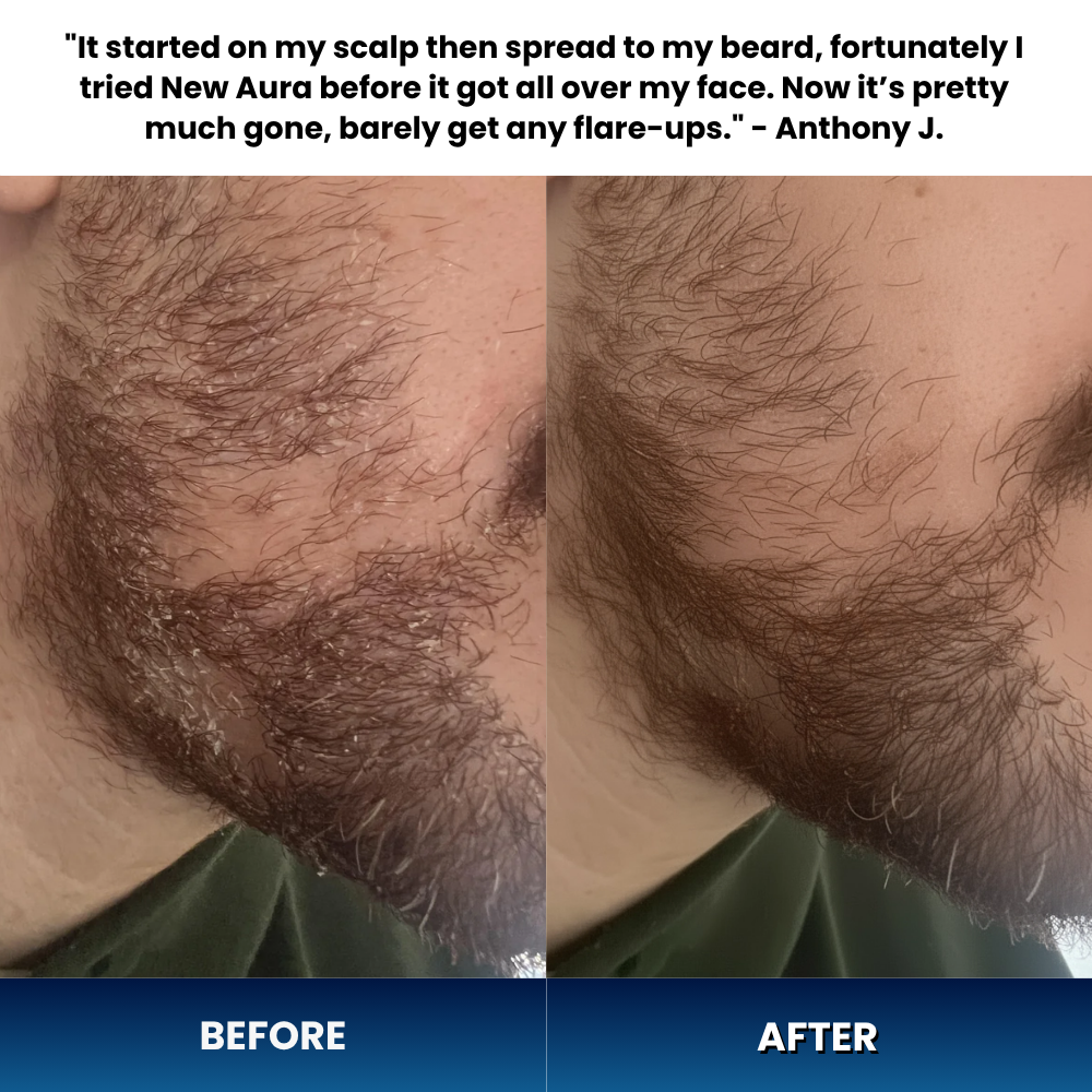 New Aura™ Anti-Fungal Beard Cream