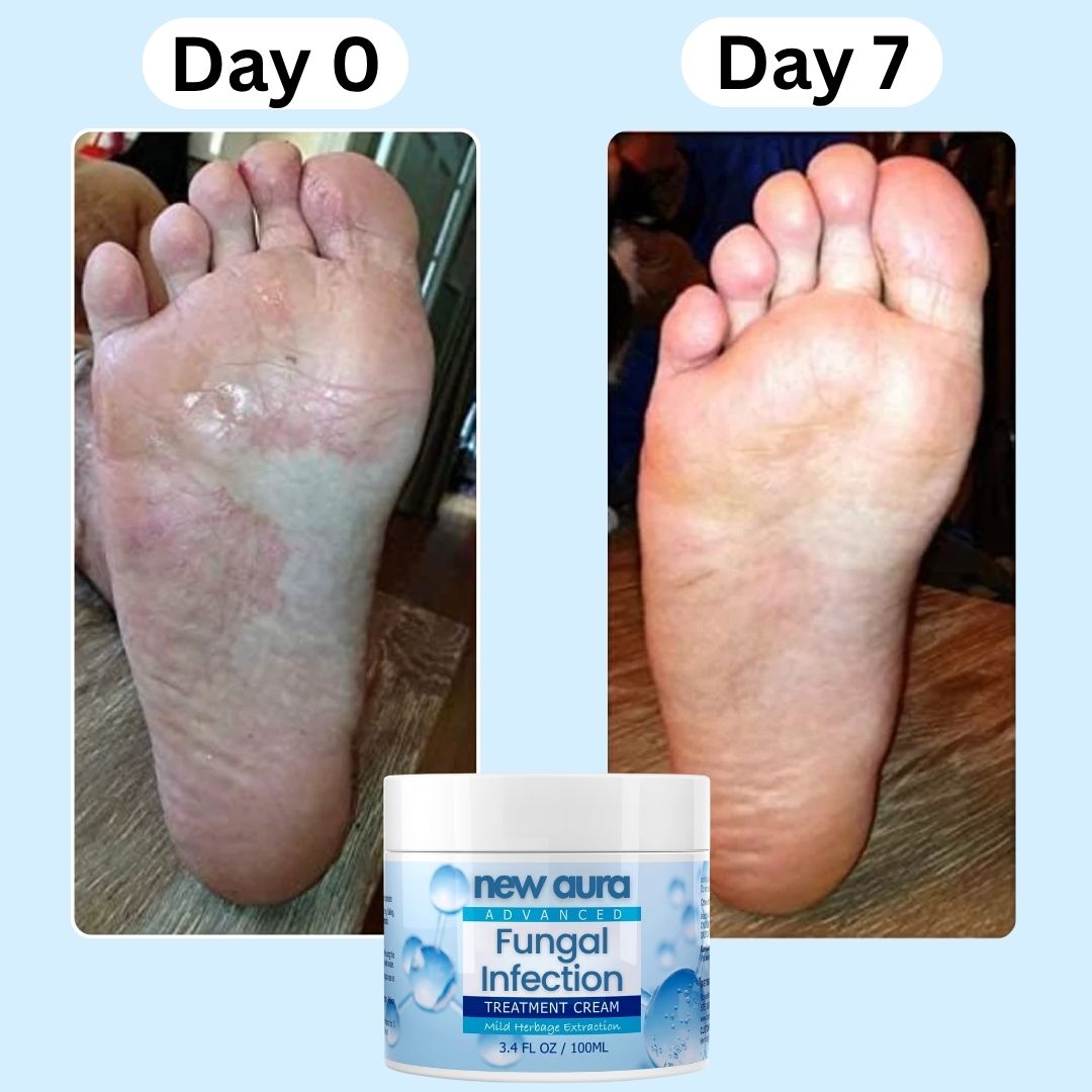 NewAura™ Fungus Cream