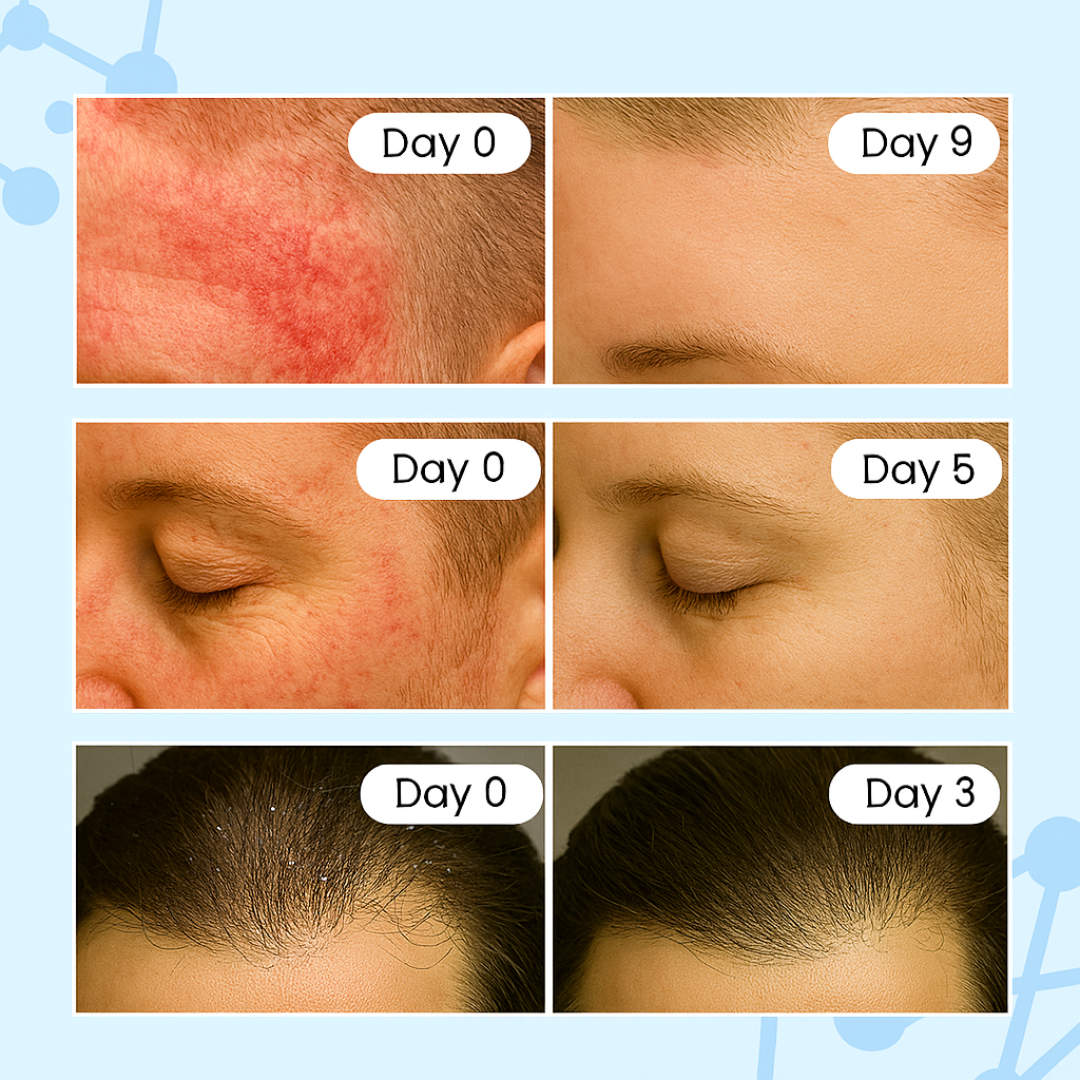 New Aura™ Anti-Fungal Scalp Cream